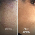 Before and after comparison of skin texture with 'Showering with Everist' text.