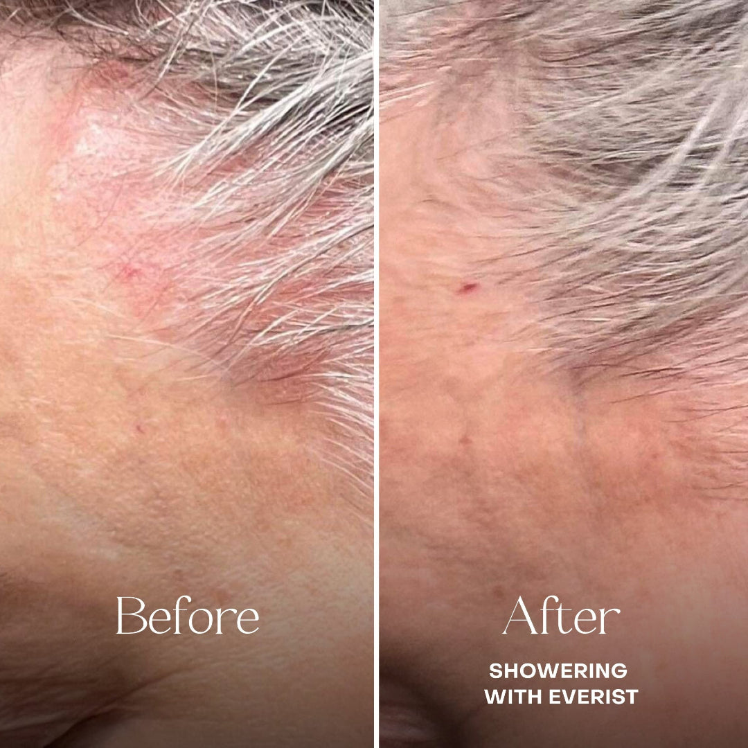 Before and after comparison of skin with 'Showering with Everist' text.